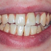 Teeth Whitening - Smile 1 before